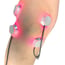 LaserPatch 650: Modulares System für Lasertherapie und Laserakupunktur