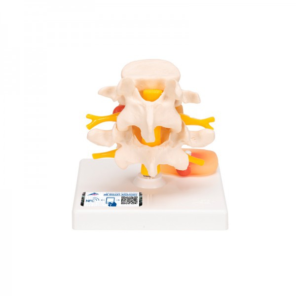 Bandscheiben der Lendenwirbelsäule mit Bandscheibenvorfall Bandscheiben der Lendenwirbelsäule mit Bandscheibenvorfall